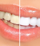 What Is Dental Whitening With Home Trays vs In-Chair Treatment?