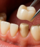 What Is a Dental Crown and When Is It the Better Option Over a Filling?